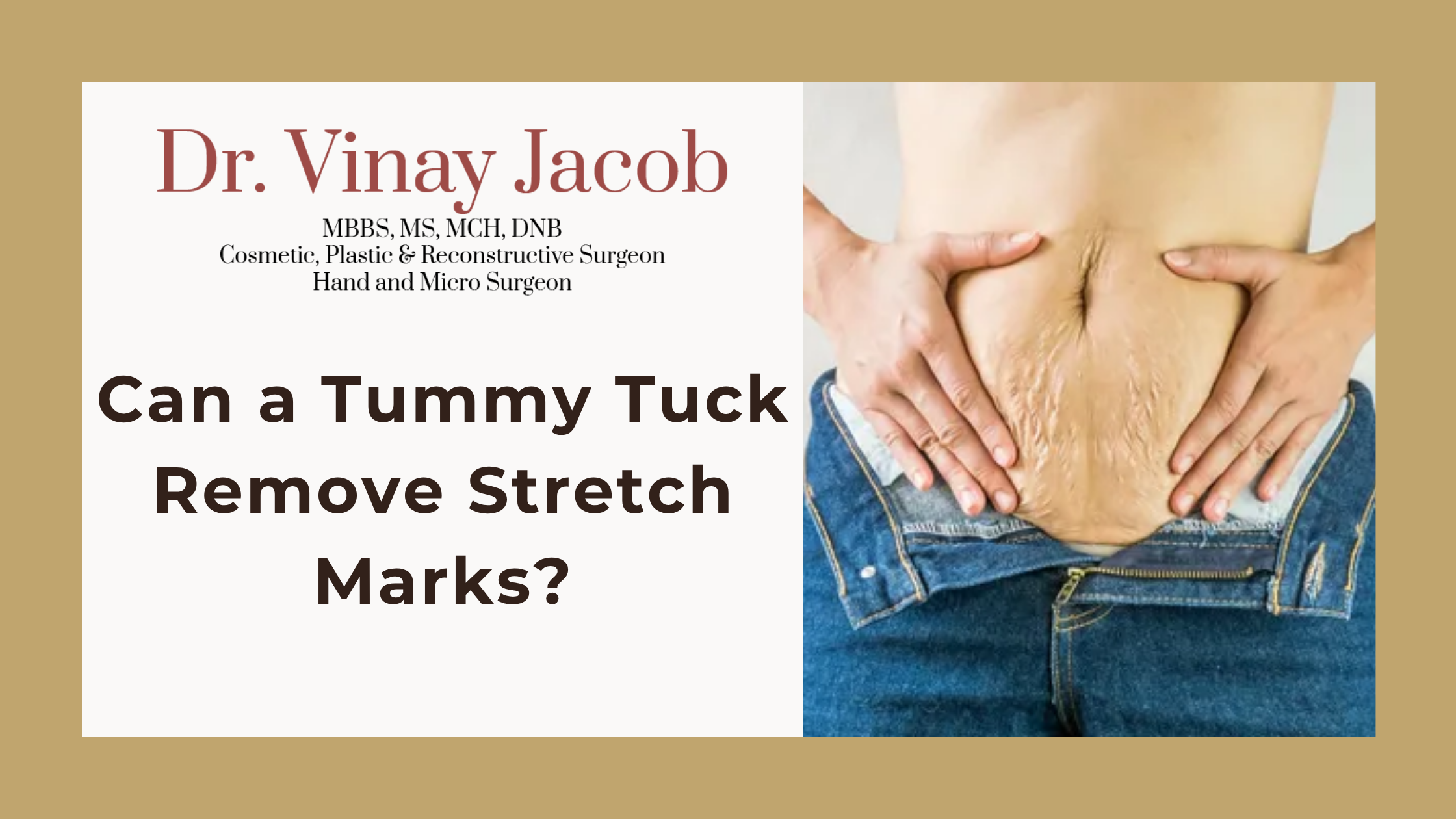 Can a Tummy Tuck Remove Stretch Marks?